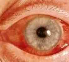 Glaukom otvorenog kuta: Simptomi i liječenje