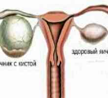 Parovarian cista jajnika - uzroci, simptomi, liječenje