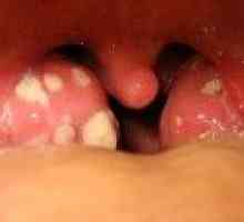 Peritonzilarnog apsces: simptoma, liječenje