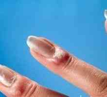 Zanoktica (infekcije noktiju) - uzroci, simptomi i liječenje