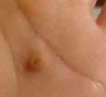Ravne bradavice na licu i rukama: liječenje i uklanjanje