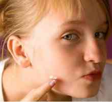 Zašto se i kako ukloniti akne na obrazima