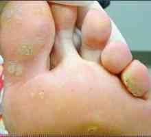 Bradavice na stopalima: Uzroci i tretmani