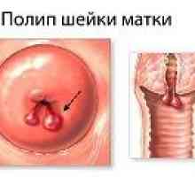 Polip u maternici za vrijeme trudnoće, uzroci, liječenje