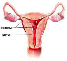Polipi u maternici: Simptomi i liječenje