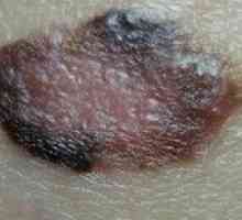 Površina melanom: simptomi, uzroci, liječenje
