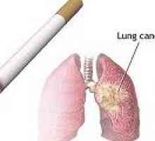 Uzroci raka pluća kod pušača