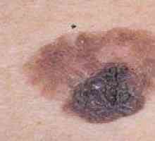 Značajke i specifičnosti liječenja melanoma fazi 3