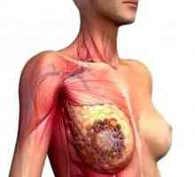Znakovi raka u žena prsne kosti
