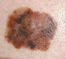 Prognoze životni vijek od melanoma kože