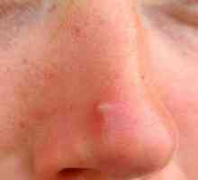 Prištići na nos: Uzroci, liječenje i prevenciju