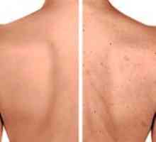 Akne na leđima: uzroci i liječenje