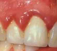 Rak zubnog mesa: uzroci, simptomi, liječenje