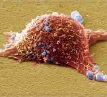 Rak kože: vrste, simptomi, metode liječenja