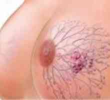Rak dojke: uzroci, simptomi, liječenje
