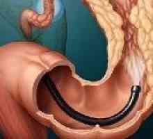 Sigmoidno raka debelog crijeva: uzroci, simptomi, liječenje