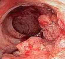 Raka debelog crijeva - tretman i prognozu
