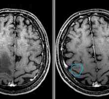 Početna faza tumora mozga