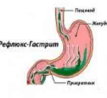 Refluks gastritis: uzroci, simptomi, liječenje