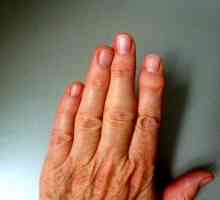 Reumatoidni artritis prstiju, prvi simptomi