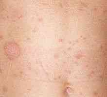 Pink zoster - fotografije, liječenje, uzrokuje kože