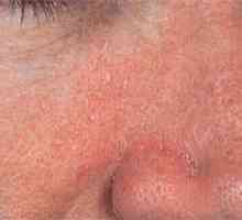 Seborejični dermatitis (ekcem uljni) lica: uzrokuje, liječenje i prevenciju