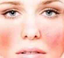 Simptomi i liječenje alergija na licu