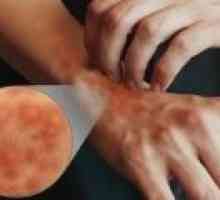 Simptomi i liječenje atopijskog dermatitisa