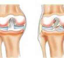 Simptomi i liječenje rupture meniskusa zgloba koljena