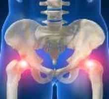 Simptomi i liječenje hip trohanterita