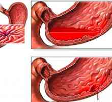 Simptomi i gastroduodenitis liječenje