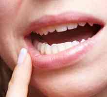 Simptomi i postupci za liječenje oralna kandidijaza