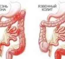 Simptomi ulceroznog kolitisa