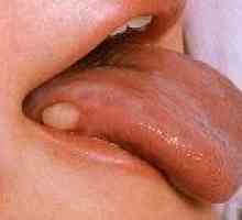 Simptomi karcinoma jezika