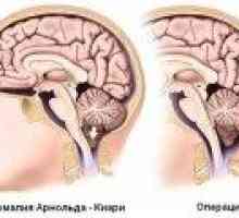 Arnold Chiari sindrom: uzroci, simptomi, liječenje