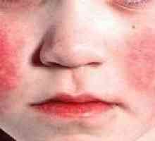 Kawasaki sindrom u djece: uzroci, dijagnoza, liječenje