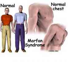 Marfan sindrom