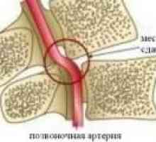 Sindrom kičmene arterije vrata maternice osteochondrosis