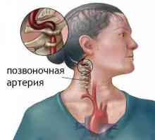Sindrom kičmene arterije u vratnoj osteochondrosis: simptoma, sprečavanje