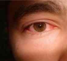 Sindroma suhog oka - uzroka, simptoma, liječenje