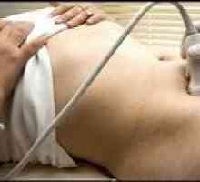 Sklerokistoz jajnika - uzroka, simptoma, liječenje