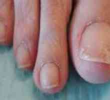 Ljuštiti nokte - uzroci i liječenje