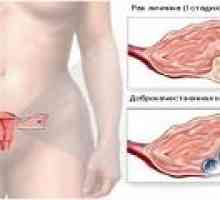Fazi raka jajnika u žena