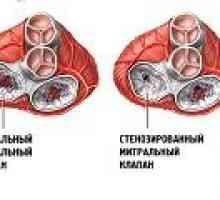 Mitralna stenoza: uzroci, simptomi, liječenje