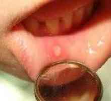Stomatitis u odraslih: što i kako se postupa stomatitis u ustima?