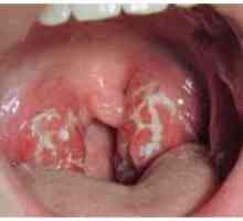 Streptokokne infekcije grla