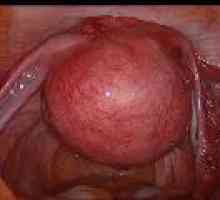 Submucous (submukozna) fibroidi maternice, simptoma, liječenje