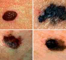 Vrste melanoma i njihovu klasifikaciju