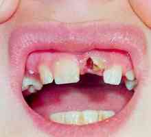 Zubni traume