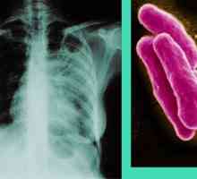 Tuberkuloza - Simptomi i znakovi